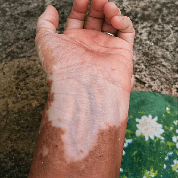 Vitiligo — Antes (foto 2)
