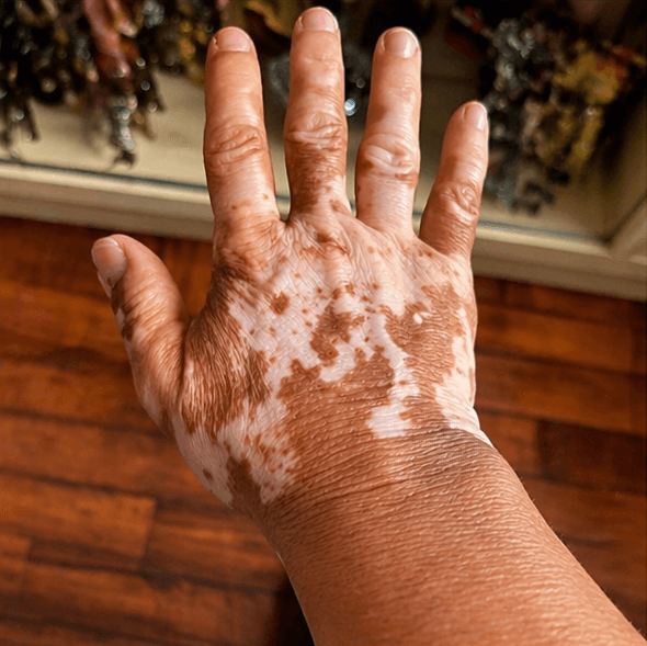 Vitiligo — Depois (foto 1)